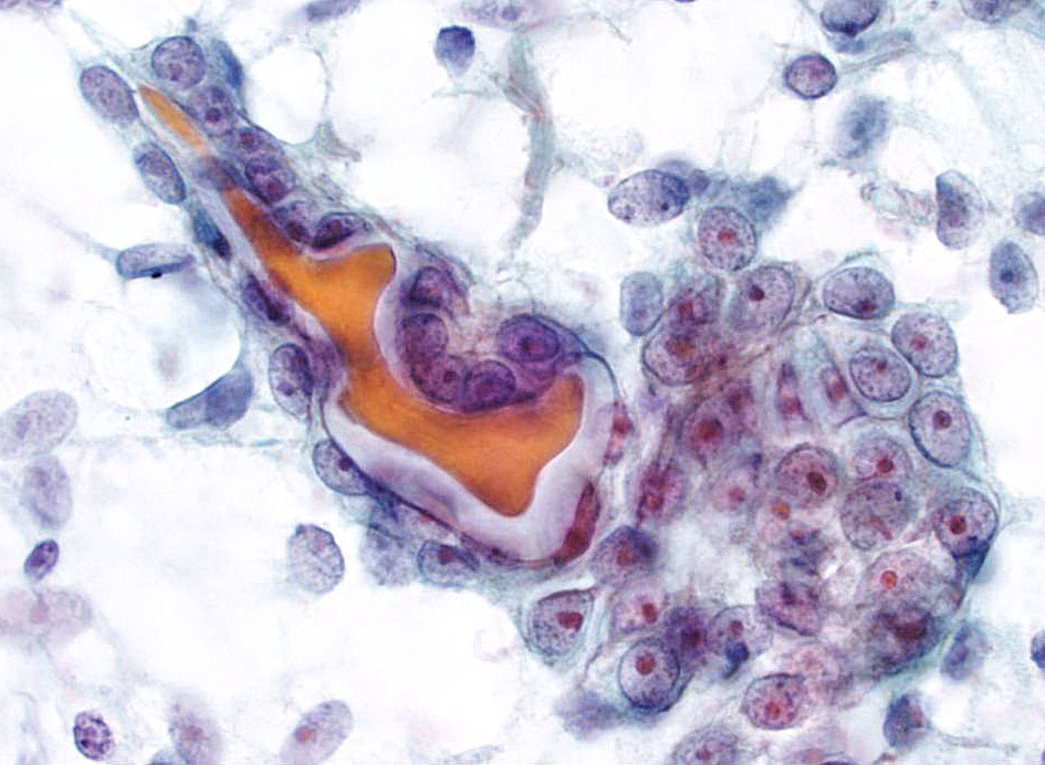 Fig. 7.10 Malignant: Epithelial-Myoepithelial Carcinoma (EMC ...