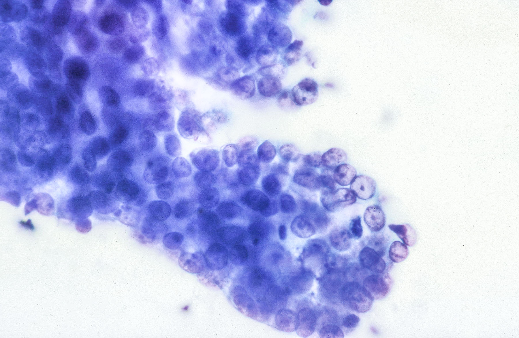 Polyamorphous Fig. 7.35b Malignant: Polymorphous Low Grade Carcinoma (PLGA ...