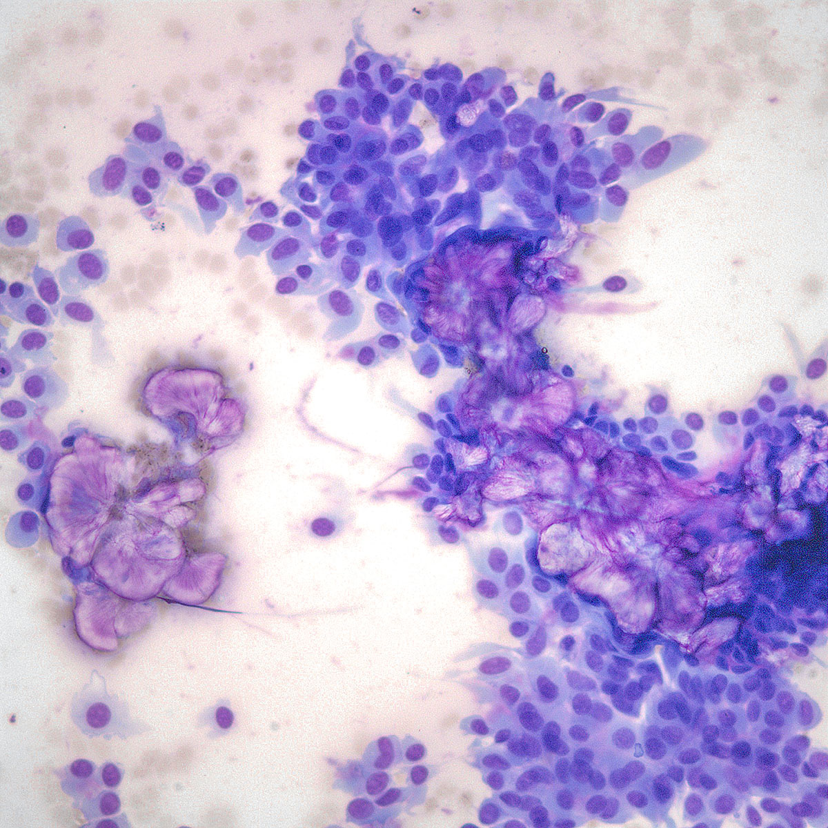 Fig. 5.19a Neoplasm: SUMP with Oncocytic Features | University of ...